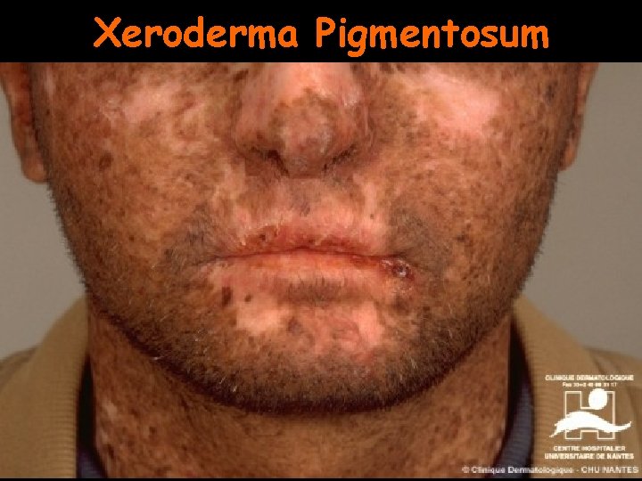 Xeroderma Pigmentosum 