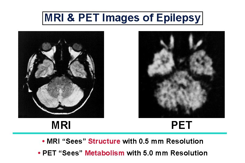 MRI & PET Images of Epilepsy MRI PET • MRI “Sees” Structure with 0.