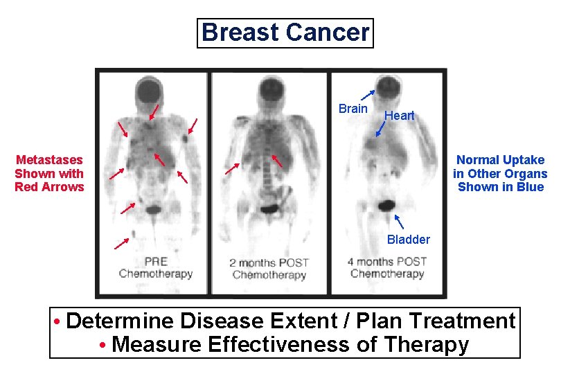 Breast Cancer Brain Heart Metastases Shown with Red Arrows Normal Uptake in Other Organs