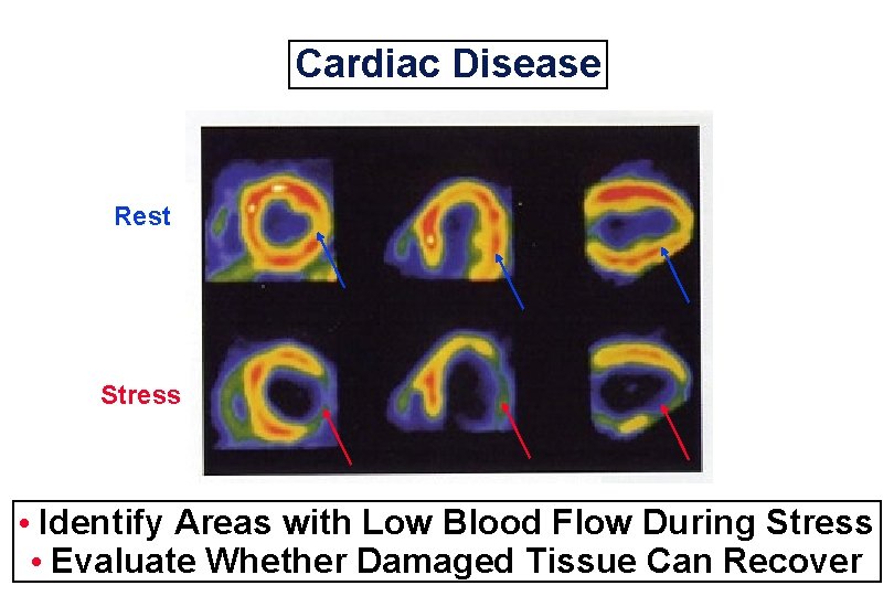 Cardiac Disease Rest Stress • Identify Areas with Low Blood Flow During Stress •