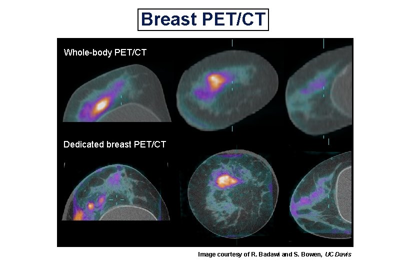 Breast PET/CT Whole-body PET/CT Dedicated breast PET/CT Image courtesy of R. Badawi and S.
