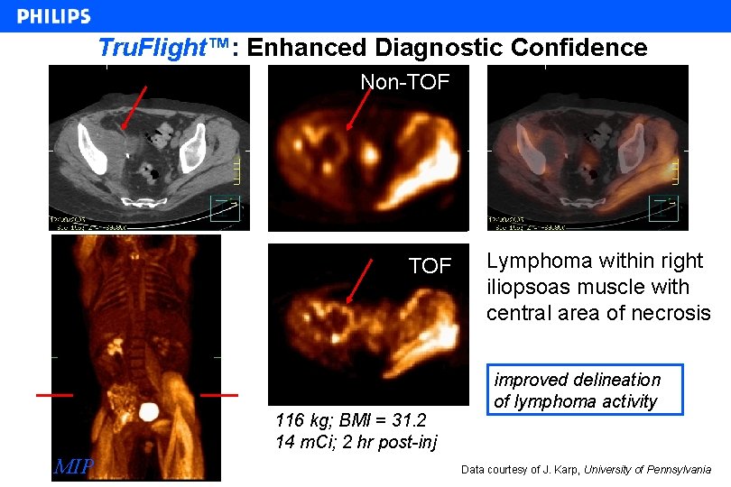 Tru. Flight™: Enhanced Diagnostic Confidence Non-TOF 116 kg; BMI = 31. 2 14 m.