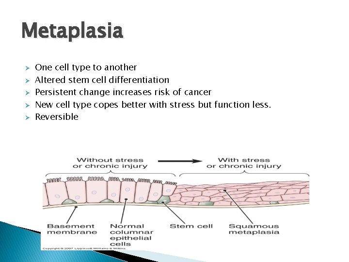 Metaplasia Ø Ø Ø One cell type to another Altered stem cell differentiation Persistent Metaplasia Ø Ø Ø One cell type to another Altered stem cell differentiation Persistent