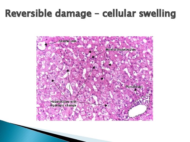Reversible damage – cellular swelling Reversible damage – cellular swelling