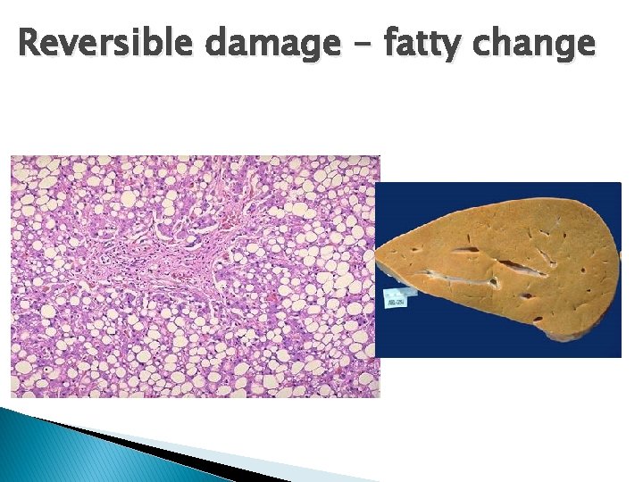 Reversible damage – fatty change . Reversible damage – fatty change .