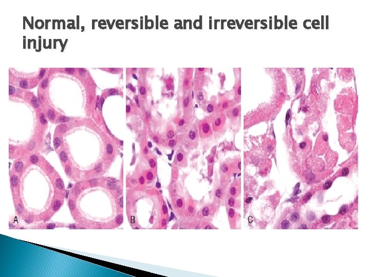 Normal, reversible and irreversible cell injury Normal, reversible and irreversible cell injury