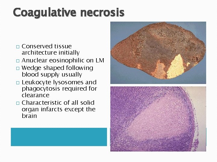 Coagulative necrosis � � � Conserved tissue architecture initially Anuclear eosinophilic on LM Wedge Coagulative necrosis � � � Conserved tissue architecture initially Anuclear eosinophilic on LM Wedge