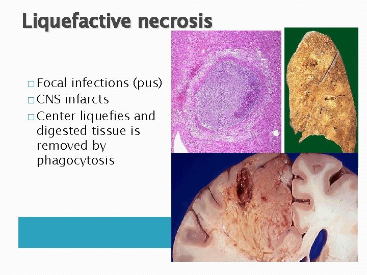 Liquefactive necrosis � Focal infections (pus) � CNS infarcts � Center liquefies and digested Liquefactive necrosis � Focal infections (pus) � CNS infarcts � Center liquefies and digested