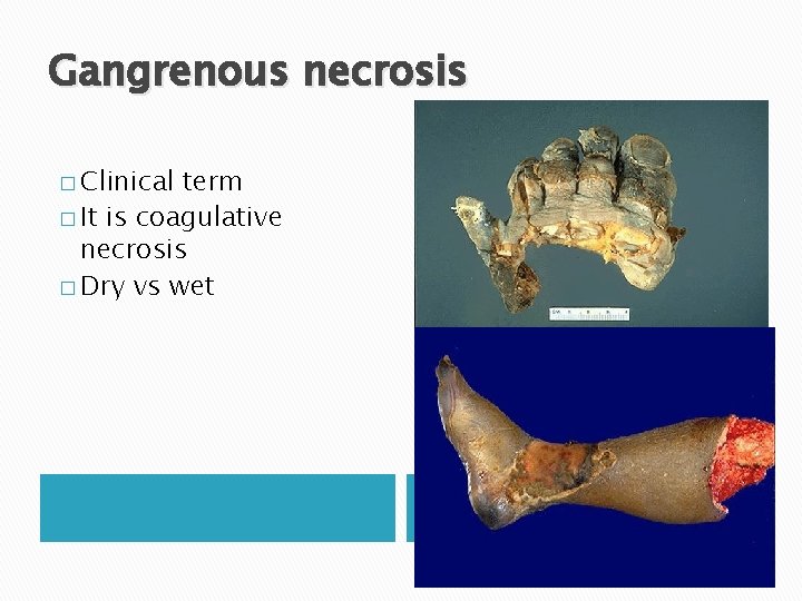 Gangrenous necrosis � Clinical term � It is coagulative necrosis � Dry vs wet Gangrenous necrosis � Clinical term � It is coagulative necrosis � Dry vs wet