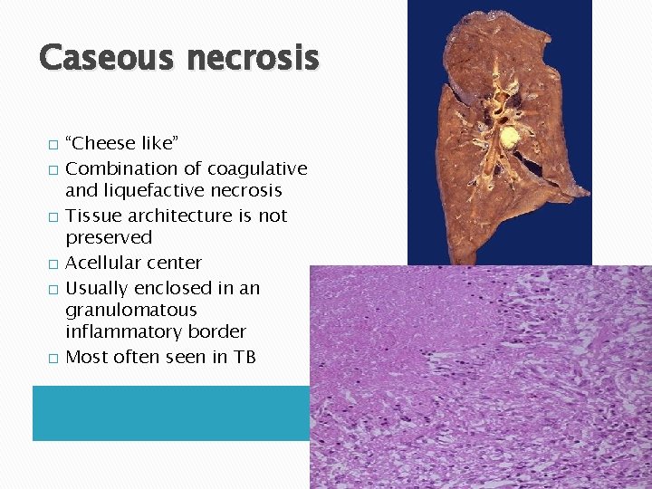 Caseous necrosis � � � “Cheese like” Combination of coagulative and liquefactive necrosis Tissue Caseous necrosis � � � “Cheese like” Combination of coagulative and liquefactive necrosis Tissue