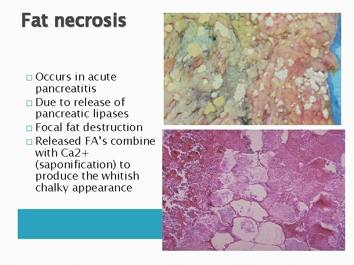 Fat necrosis Occurs in acute pancreatitis � Due to release of pancreatic lipases � Fat necrosis Occurs in acute pancreatitis � Due to release of pancreatic lipases �