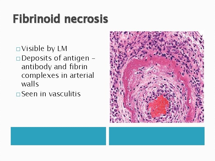 Fibrinoid necrosis � Visible by LM � Deposits of antigen – antibody and fibrin Fibrinoid necrosis � Visible by LM � Deposits of antigen – antibody and fibrin