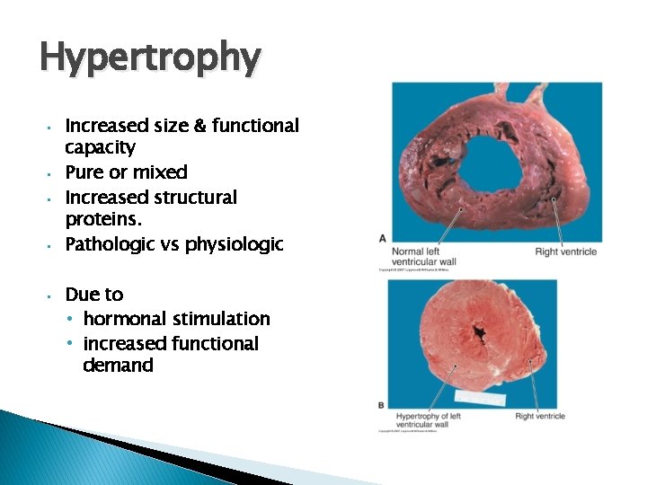 Hypertrophy • • • Increased size & functional capacity Pure or mixed Increased structural Hypertrophy • • • Increased size & functional capacity Pure or mixed Increased structural