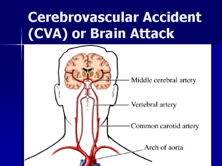 Cerebrovascular Accident (CVA) or Brain Attack 