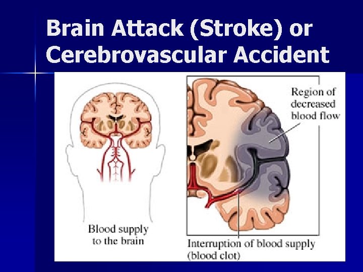 Brain Attack (Stroke) or Cerebrovascular Accident 