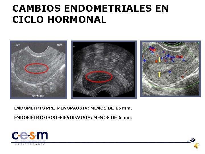 CAMBIOS ENDOMETRIALES EN CICLO HORMONAL ENDOMETRIO PRE-MENOPAUSIA: MENOS DE 15 mm. ENDOMETRIO POST-MENOPAUSIA: MENOS