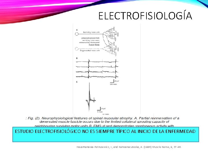 ELECTROFISIOLOGÍA ESTUDIO ELECTROFISIOLÓGICO NO ES SIEMPRE TÍPICO AL INICIO DE LA ENFERMEDAD Hausmanowa-Petrusewicz, I.