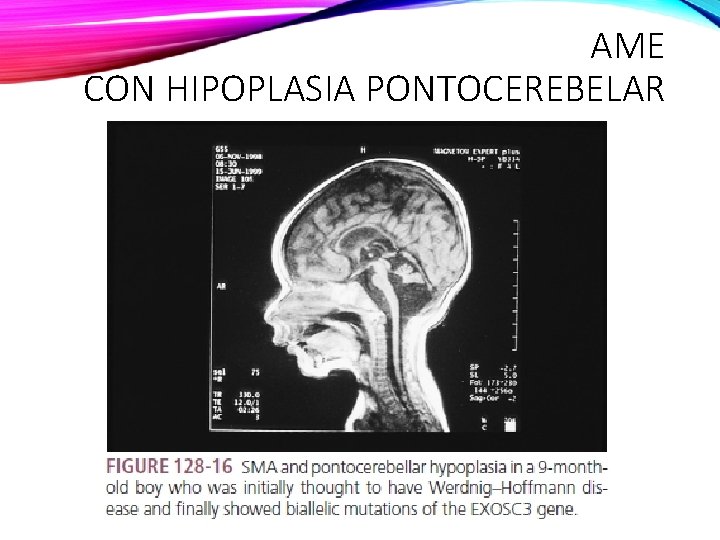 AME CON HIPOPLASIA PONTOCEREBELAR 