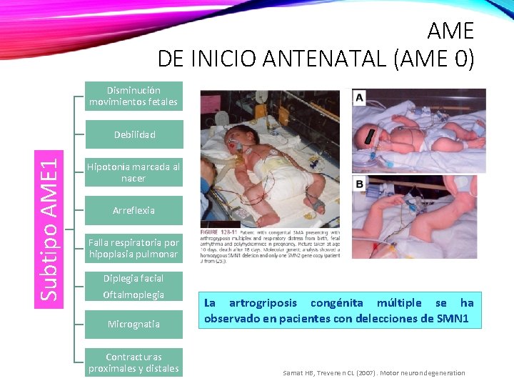 AME DE INICIO ANTENATAL (AME 0) Disminución movimientos fetales Subtipo AME 1 Debilidad Hipotonía