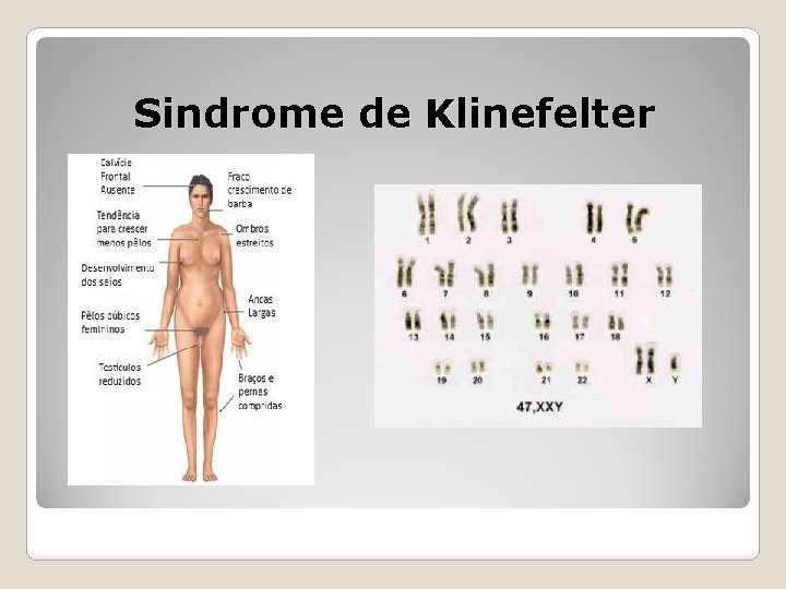 Sindrome de Klinefelter 