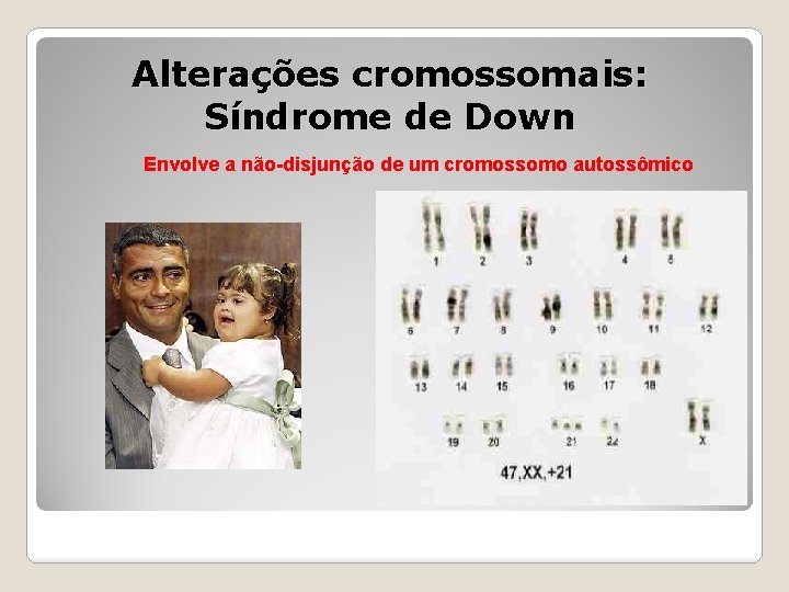 Alterações cromossomais: Síndrome de Down Envolve a não-disjunção de um cromossomo autossômico 