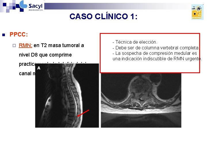 CASO CLÍNICO 1: n PPCC: ¨ RMN: en T 2 masa tumoral a nivel CASO CLÍNICO 1: n PPCC: ¨ RMN: en T 2 masa tumoral a nivel