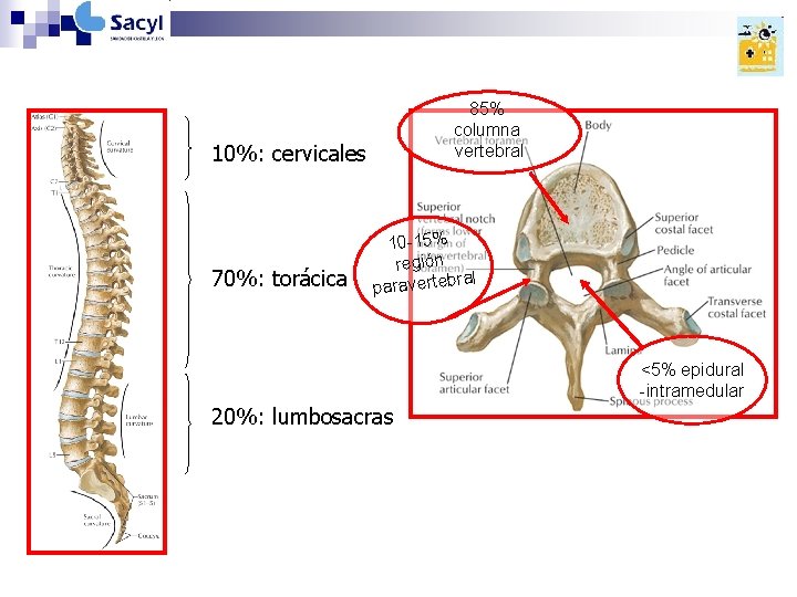 85% columna vertebral 10%: cervicales 70%: torácica 10 -15% región al paravertebr <5% epidural 85% columna vertebral 10%: cervicales 70%: torácica 10 -15% región al paravertebr <5% epidural