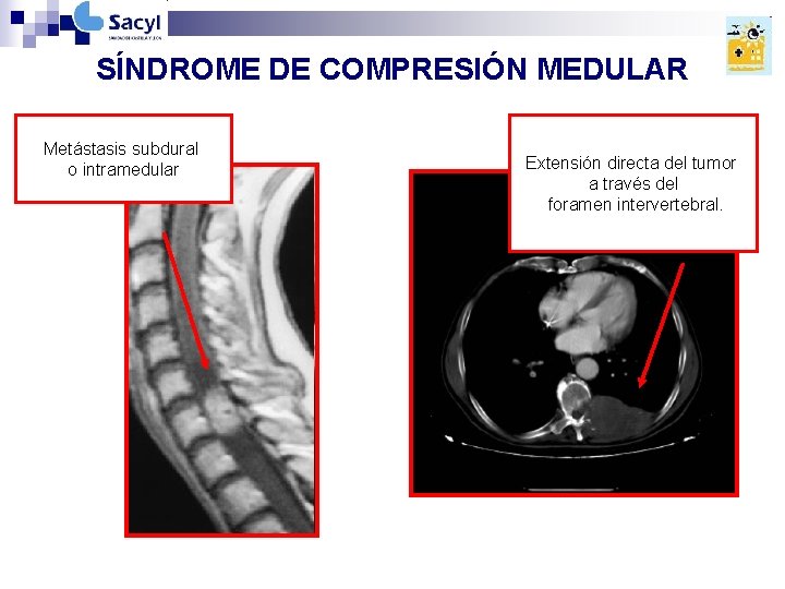 SÍNDROME DE COMPRESIÓN MEDULAR Metástasis subdural o intramedular Extensión directa del tumor a través SÍNDROME DE COMPRESIÓN MEDULAR Metástasis subdural o intramedular Extensión directa del tumor a través