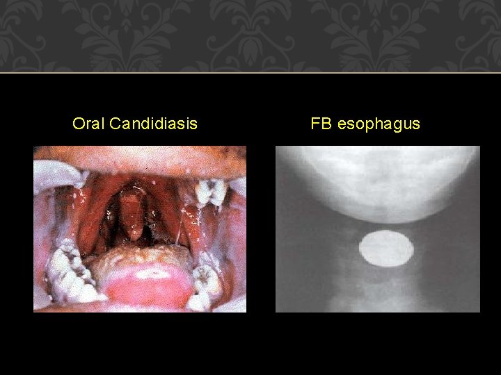Oral Candidiasis FB esophagus 