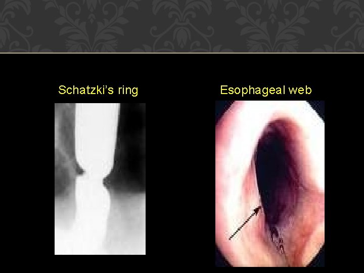 Schatzki’s ring Esophageal web 