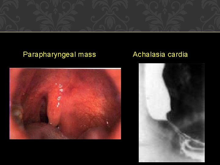 Parapharyngeal mass Achalasia cardia 