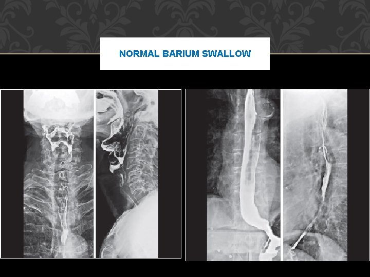 NORMAL BARIUM SWALLOW 