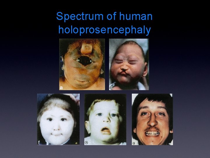 Spectrum of human holoprosencephaly 
