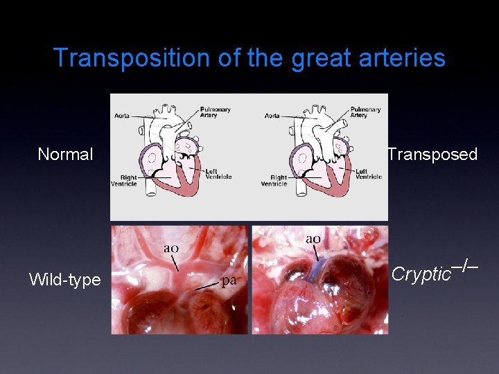 Transposition of the great arteries Normal Transposed Wild-type Cryptic–/– 