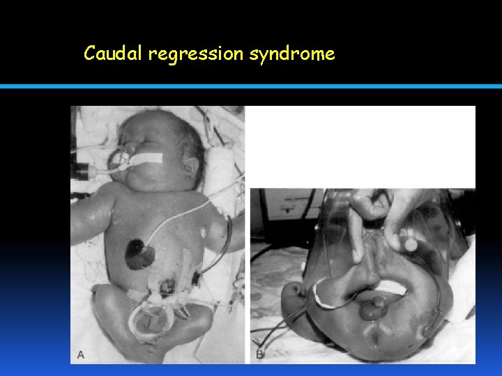 Caudal regression syndrome 