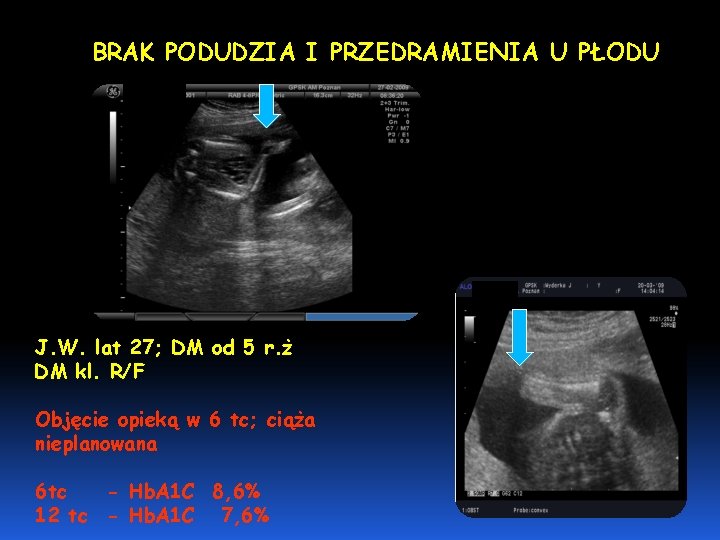 BRAK PODUDZIA I PRZEDRAMIENIA U PŁODU J. W. lat 27; DM od 5 r.