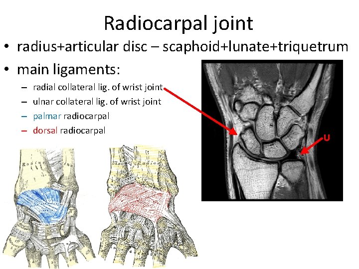 Radiocarpal joint • radius+articular disc – scaphoid+lunate+triquetrum • main ligaments: – – radial collateral