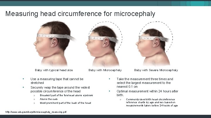 Measuring head circumference for microcephaly Baby with typical head size • • Baby with