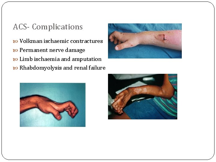 ACS- Complications Volkman ischaemic contractures Permanent nerve damage Limb ischaemia and amputation Rhabdomyolysis and