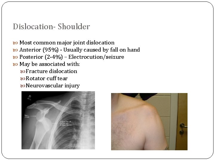 Dislocation- Shoulder Most common major joint dislocation Anterior (95%) - Usually caused by fall