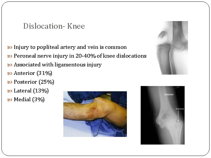 Dislocation- Knee Injury to popliteal artery and vein is common Peroneal nerve injury in