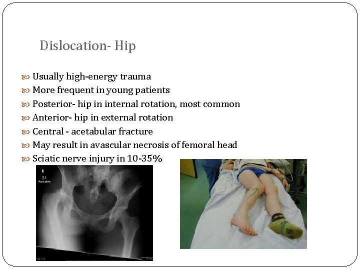 Dislocation- Hip Usually high-energy trauma More frequent in young patients Posterior- hip in internal