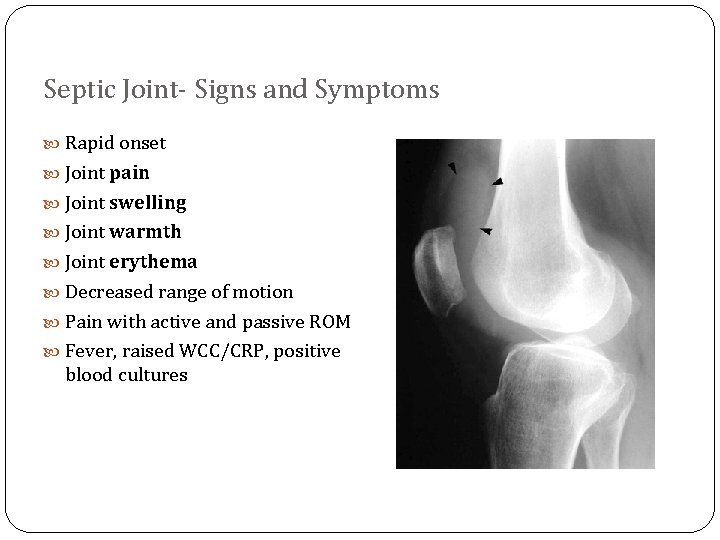 Septic Joint- Signs and Symptoms Rapid onset Joint pain Joint swelling Joint warmth Joint