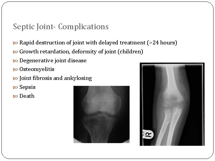 Septic Joint- Complications Rapid destruction of joint with delayed treatment (>24 hours) Growth retardation,