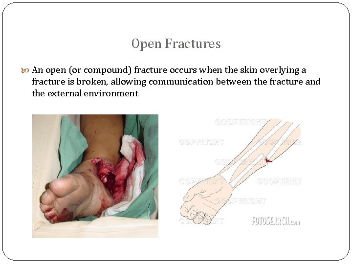 Open Fractures An open (or compound) fracture occurs when the skin overlying a fracture