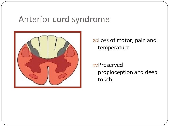 Anterior cord syndrome Loss of motor, pain and temperature Preserved propioception and deep touch