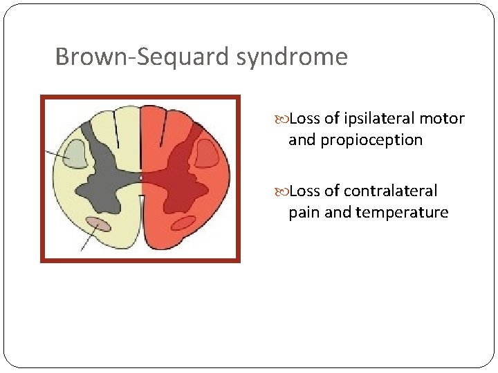 Brown-Sequard syndrome Loss of ipsilateral motor and propioception Loss of contralateral pain and temperature