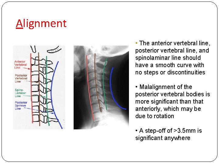 Alignment • The anterior vertebral line, posterior vertebral line, and spinolaminar line should have