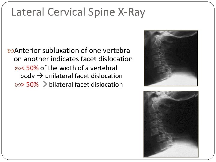 Lateral Cervical Spine X-Ray Anterior subluxation of one vertebra on another indicates facet dislocation