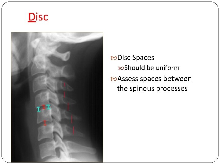 Disc Spaces Should be uniform Assess spaces between the spinous processes 
